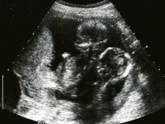 Развитие двойни на 16 неделе беременности