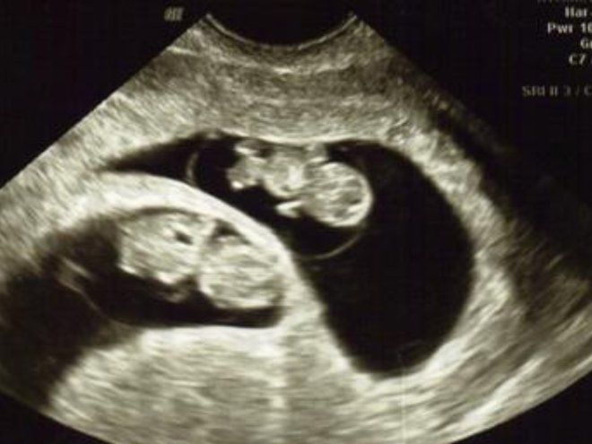 Развитие двойни на 9 неделе беременности