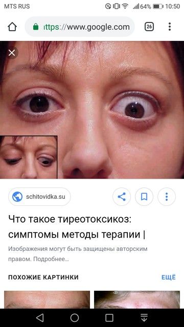 Офтольмопатия Офтольмопатия